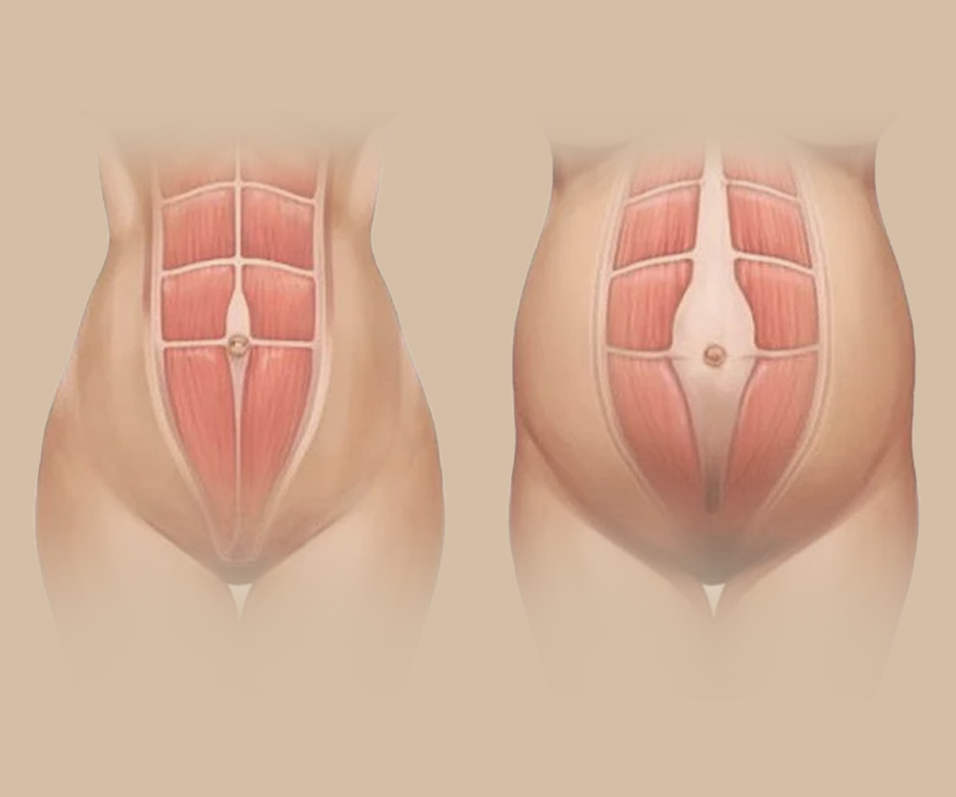 Diástase Abdominal: Mitos, Verdades e a Única Solução para um Abdômen Firme